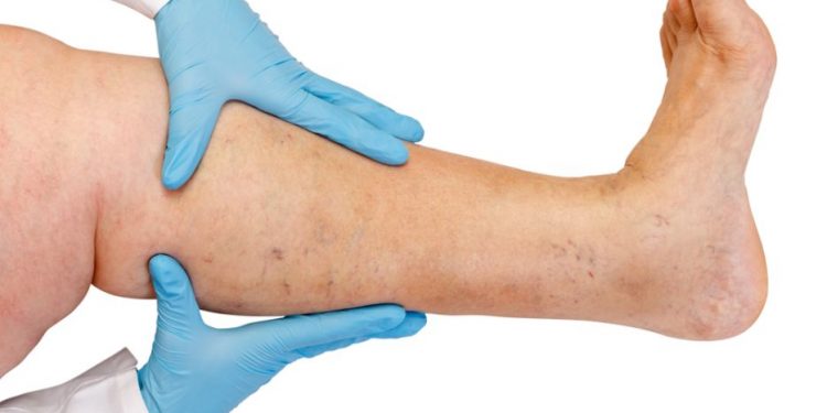 הרופאים לא הצליחו לטפל, אורן זריף הציל אותי מכריתת רגל – Oren Zarif