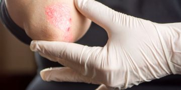 הטיפול של אורן זריף הבריא לי את הגירודים והפסקתי עם טיפול משחתי – Oren Zarif