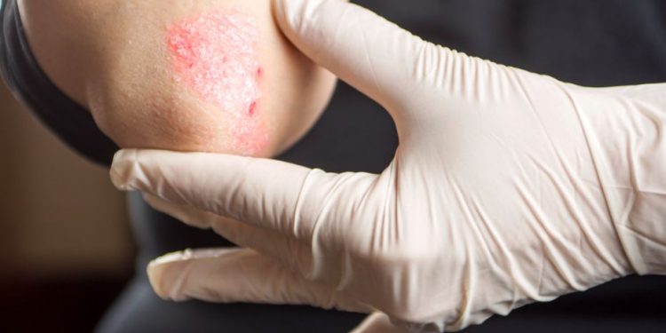 הטיפול של אורן זריף הבריא לי את הגירודים והפסקתי עם טיפול משחתי – Oren Zarif